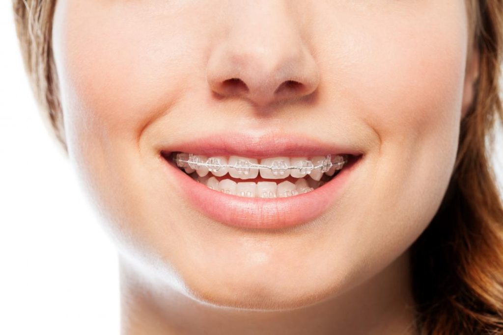 Do Adults Need Orthodontic Treatments?