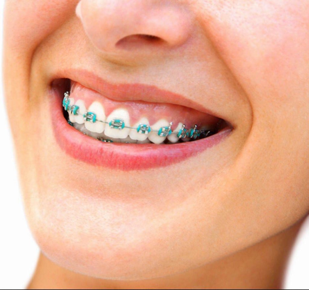 affordable-braces-near-me-miami-orthodontist-specialist